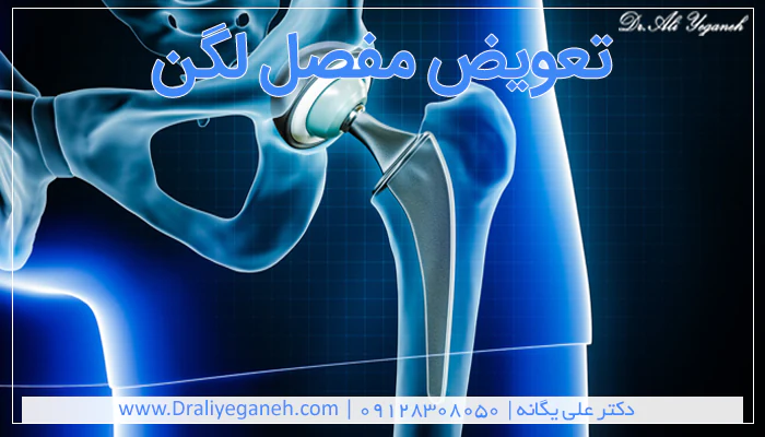 تعویض مفصل لگن
