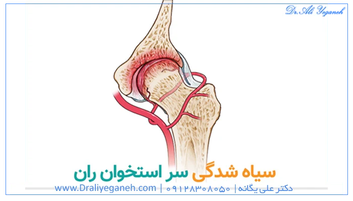 سیاه شدن سر استخوان ران